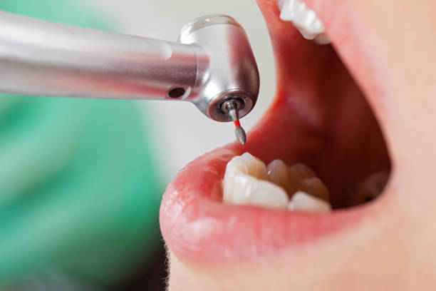 Best Lost Filling or Crown Replacement in Herriman, UT